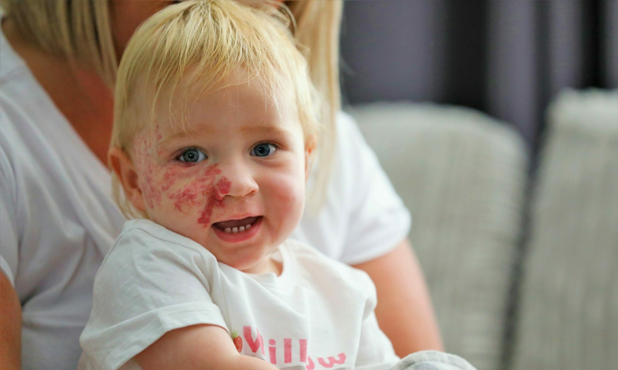 How baby Willow born with face birthmark helps families in Tayside